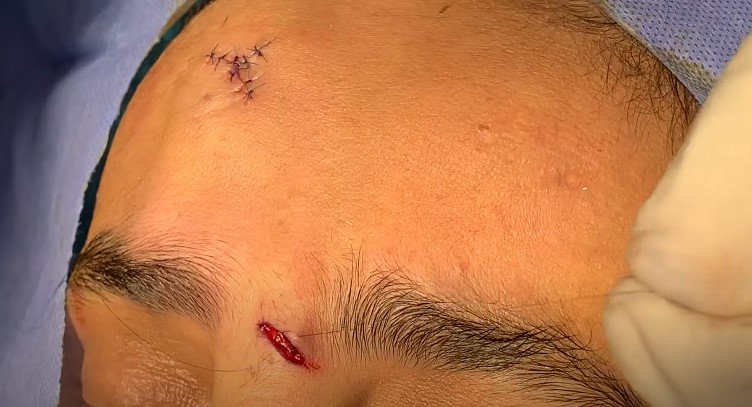 forehead suturing