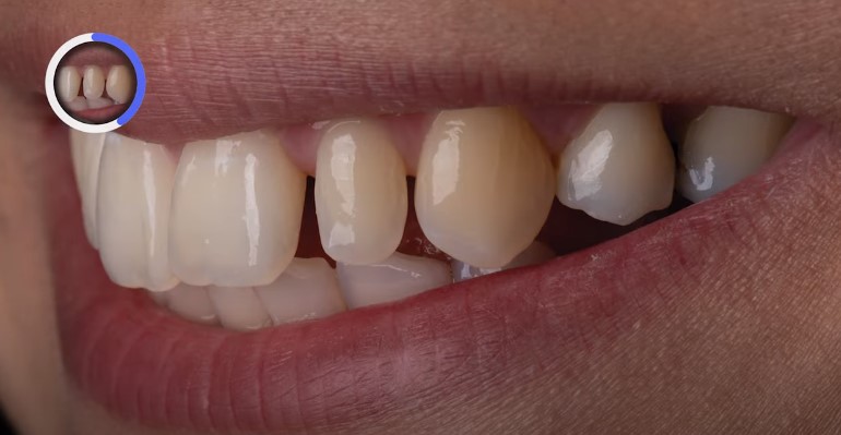 Anterior teeth