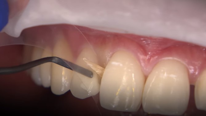 removing in between teeth