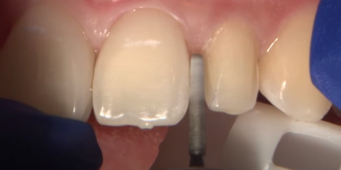 trimming teeth edges