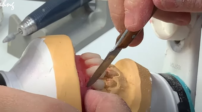 Fixing the denture gaps